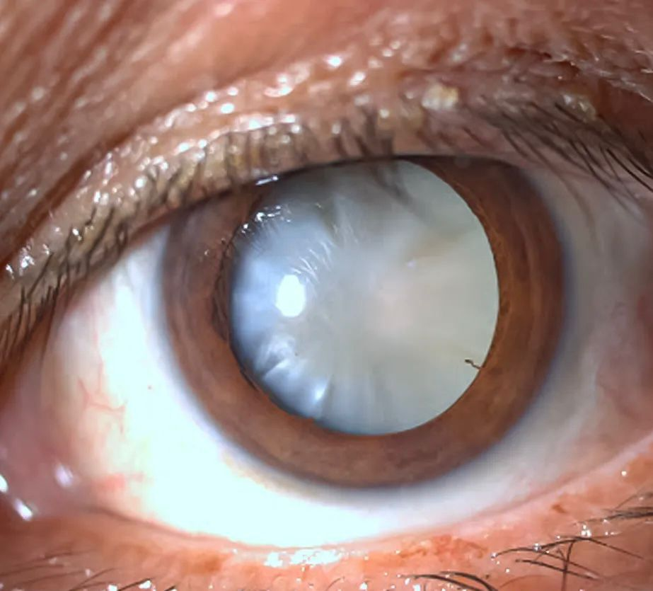 CIRURGIA DE CATARATA